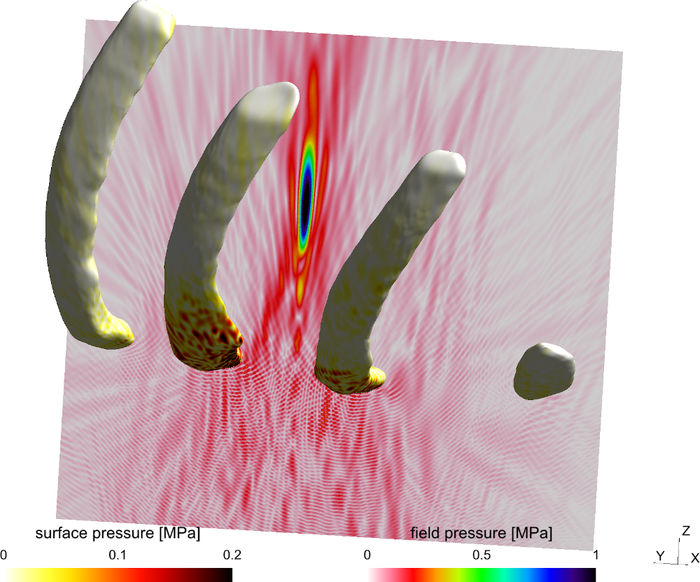 High-intensity focused ultrasound